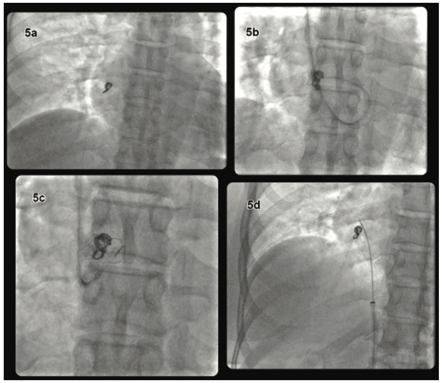 Coil Embolization to the Right Side of the Heart After Elective
